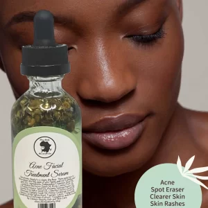 Acne Facial Serum